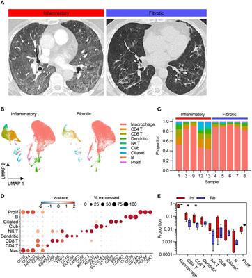 Single-cell analysis of bronchoalveolar cells in inflammatory and fibrotic post-COVID lung disease